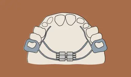 Upper teeth with a palate expander designed to improve smiles with gentle care.