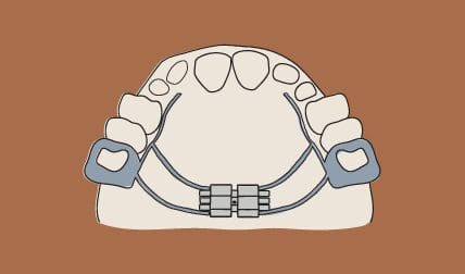 dr-wax-orthodontics-dr-wax-orthoontics-expanders-new