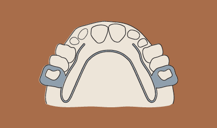 dr-wax-orthodontics-dr-wax-orthoontics-expanders