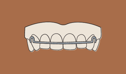 dr-wax-orthodontics-dr-wax-orthoontics-retainer-program